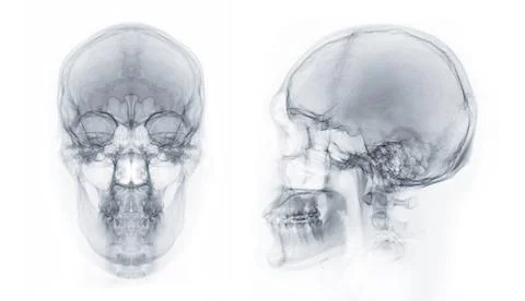 X-ray image of Human Skull  AP and Lateral view for diagnosis skull fractur.. Stock-Illustration