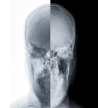 X-ray image of Human Skull  town's view for diagnosis skull fracture  isola.. Illustrazione stock