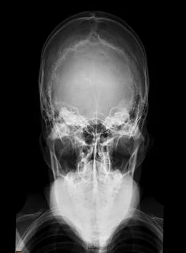 X-ray image of Human Skull  town's view for diagnosis skull fracture  isola.. Stock Illustration