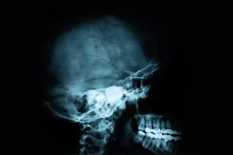 X-Ray Image Of Human Skull Fotos de archivo