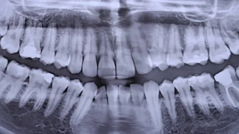 X-ray Image of the Jaw of All Human Teeth Close-up Stock Footage 232939655
