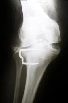 X-ray image of knee front view with a clave after a fracture. Stock Photos