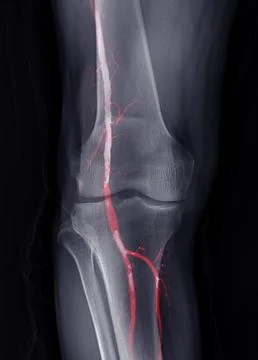 X-ray image of knee joint Fusion  with CTA Femoral run off . Illustrazione stock