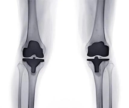 X-ray image of knee joint AP  view reveals Knee Replacement. Illustrazione stock