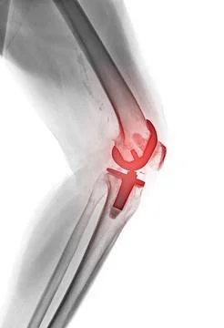 X-ray image of knee joint Lateral view reveals Knee Replacement. Stock Illustration