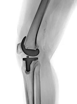 X-ray image of knee joint Lateral view reveals Knee Replacement. Stock Illustration