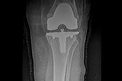 X-Ray image of knee prosthesis Stock Photos