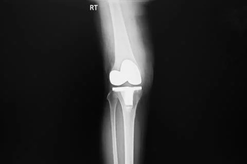 X-ray image of lateral and anteroposterior Right knee joint with total knee. Foto stock