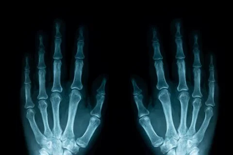 X-ray image of left and right human hands Stock Photos