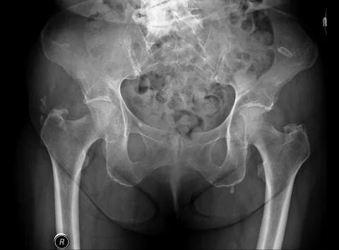 X-RAY image of male pelvis with osteoporosis Stock Photos