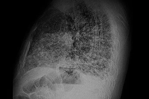 X- Ray image: Multiple small bilateral nodular lesions on the left lung. Stock Photos