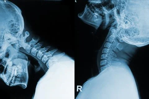 X-ray image of neck show neck pain in flex and exten position Stock Photos