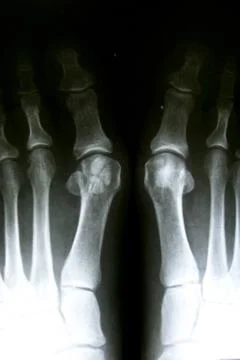 X-ray image of normal foot both side. Stock Photos