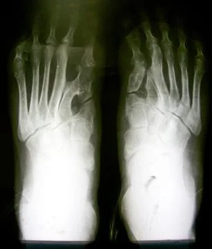 X-ray image of normal foot both side. Foto stock