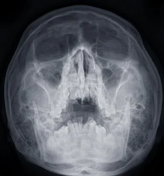 X-ray image of paranasal sinuses for diagnosis sinusitis. Stock-Illustration