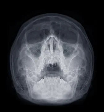 X-ray image of paranasal sinuses for diagnosis sinusitis. Stock Illustration