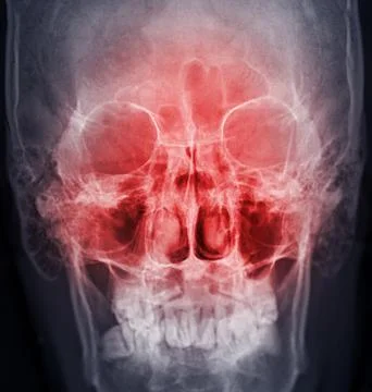 X-ray image of paranasal sinuses for diagnosis sinusitis. 스톡 일러스트