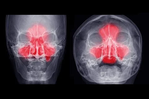 X-ray image of paranasal sinuses Ap and water's view for diagnosis sinusitis. 스톡 일러스트