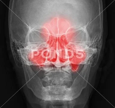 paranasal sinuses x ray