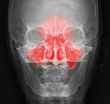 X-ray image of paranasal sinuses for diagnosis sinusitis. Stock Illustration