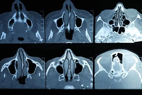 X-ray image of paranasal sinuses as background Stock Photos