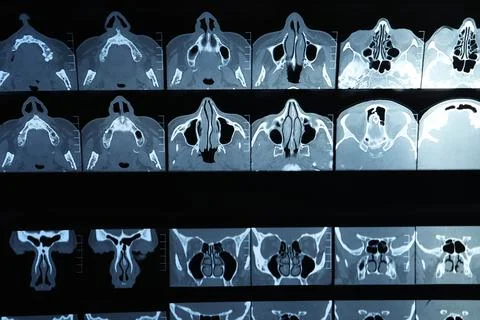 X-ray image of paranasal sinuses as background Stock Photos