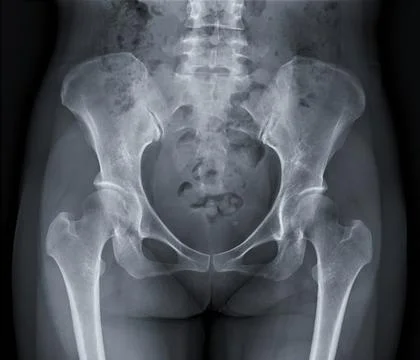 X-ray image of Pelvic bone. Stock Illustration
