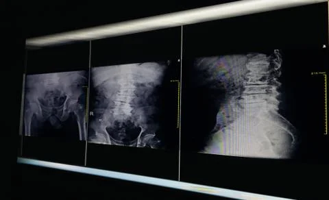 X-ray image pelvic bone and hip joint, degenerative change L4-5 lumbar Scolio Stock Photos