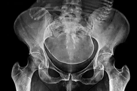 X- ray image of a pelvimetry Stock Photos
