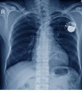X-ray image of permanent pacemaker implant in chest body , process in blue to Stock Photos