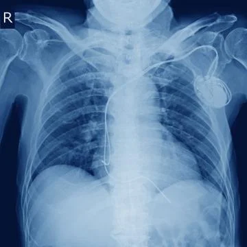 X-ray image of permanent pacemaker implant in body chest. Stock Photos