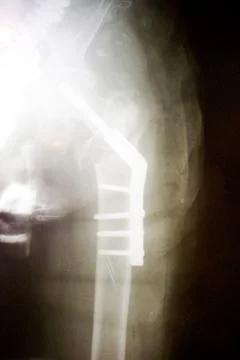 X-ray image of right side human hip fracture neck of femur bone. Open Reducti Stock Photos