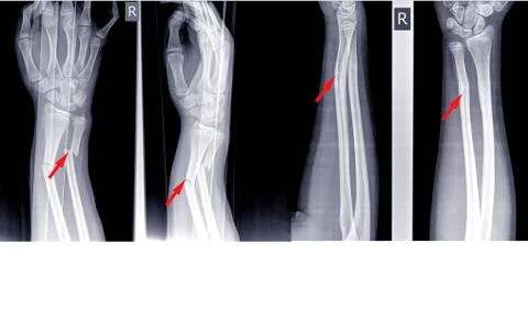 X-ray image right of wrist joint, shows fracture of the distal radius and uln Stock Photos