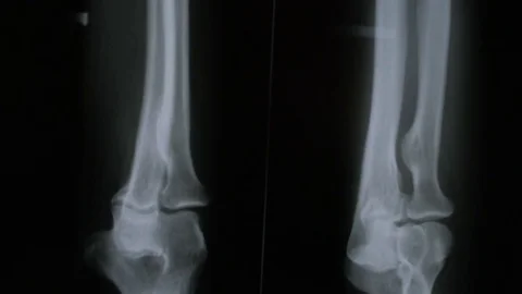 x-ray image show fracture of arm bone,sh... | Stock Video | Pond5