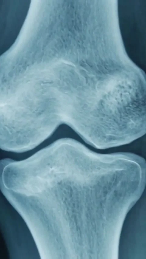 X-ray image showing the skeletal anatomy of a human knee joint, Stock Footage 340318427