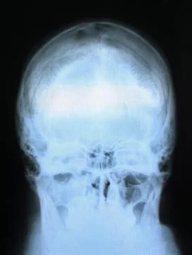 X-ray image of the skull from the back. Stock Photos