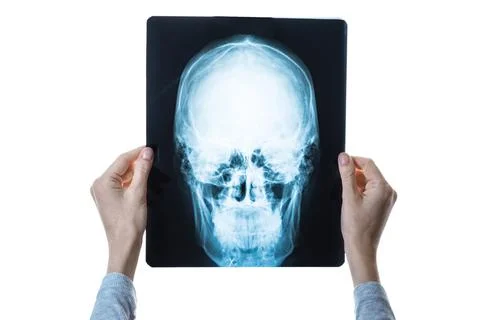 X-ray image of skull in hands Stock Photos