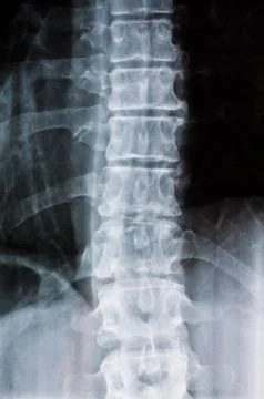 X-ray image of a spine Stock-Fotos