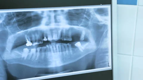 X-ray image of teeth Video stock 67561434