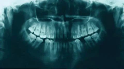 X-ray image of teeth people, stomatology concept Stock Photos