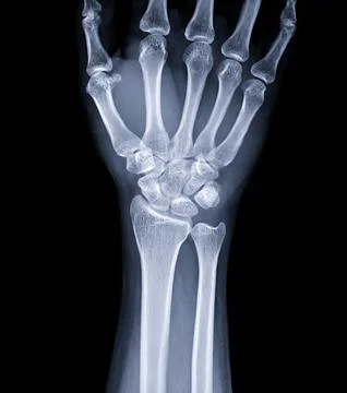 X-ray image of wrist joint for diagnosis rheumatoid arthritis . Stock Illustration