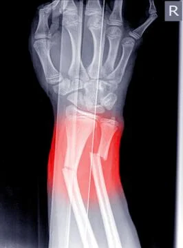 X-ray image of wrist joint, shows fracture of the distal radius and ulna on c Stock Photos