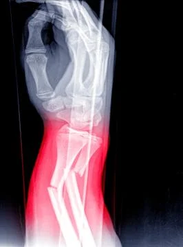 X-ray image of wrist joint, shows fracture of the distal radius and ulna on c Stock Photos