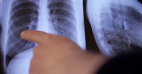 X-ray images of the lungs and chest are being reviewed by a doctor on a whi.. Stock Footage 332411818