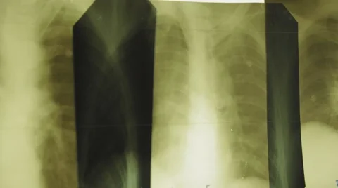 X-ray images on the viewing screen handheld shot Stock Footage 51446148