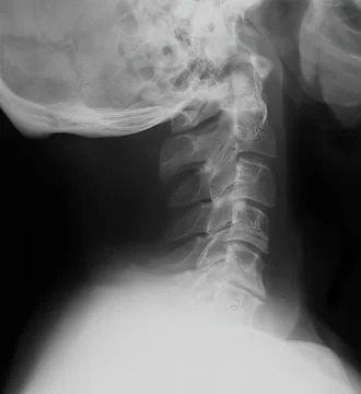 X-ray imaging human cervical spine in lateral view, showing neck vertebrae .. Stock Photos
