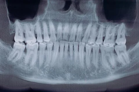 X-ray jaw front view ,concept medical , health care, Stock Photos