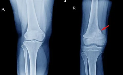 X-ray Knee AP views Showing  Normal knee joint and fracture distal femur. Stock Photos