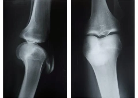 X-ray of knee caps Stock Photos