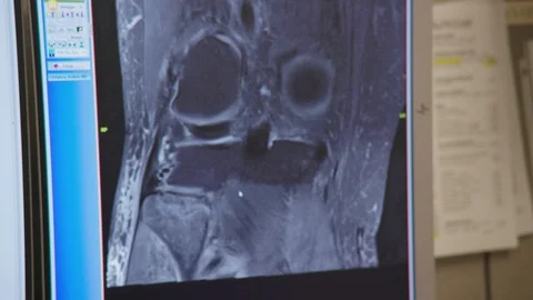X-ray of a knee on a computer Stock Footage 103867599